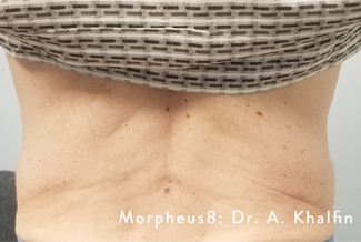 След процедура с Morpheus8