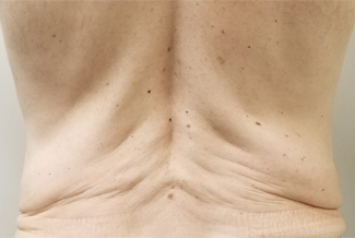 Преди процедура с Morpheus8