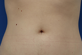 След процедура с Morpheus8