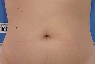 Преди процедура с Morpheus8