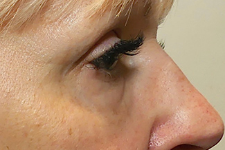 След процедура с Morpheus8_