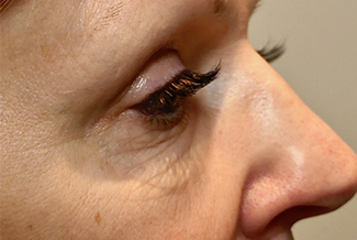 Преди процедура с Morpheus8_