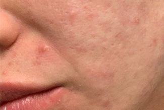 Преди процедура с Morpheus8