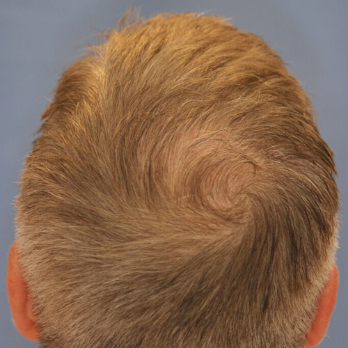 След процедура с апарат NeoGraft