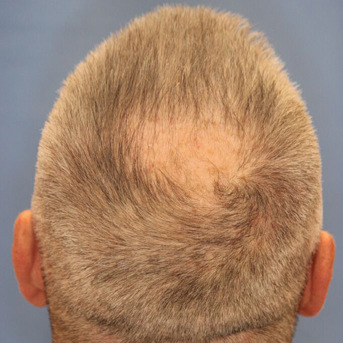 Преди процедура с апарат NeoGraft