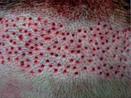 технология NeoGraft