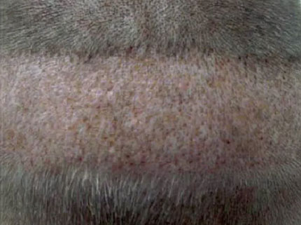 технология NeoGraft