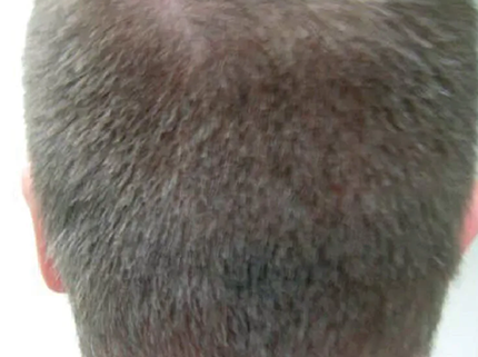 технология NeoGraft