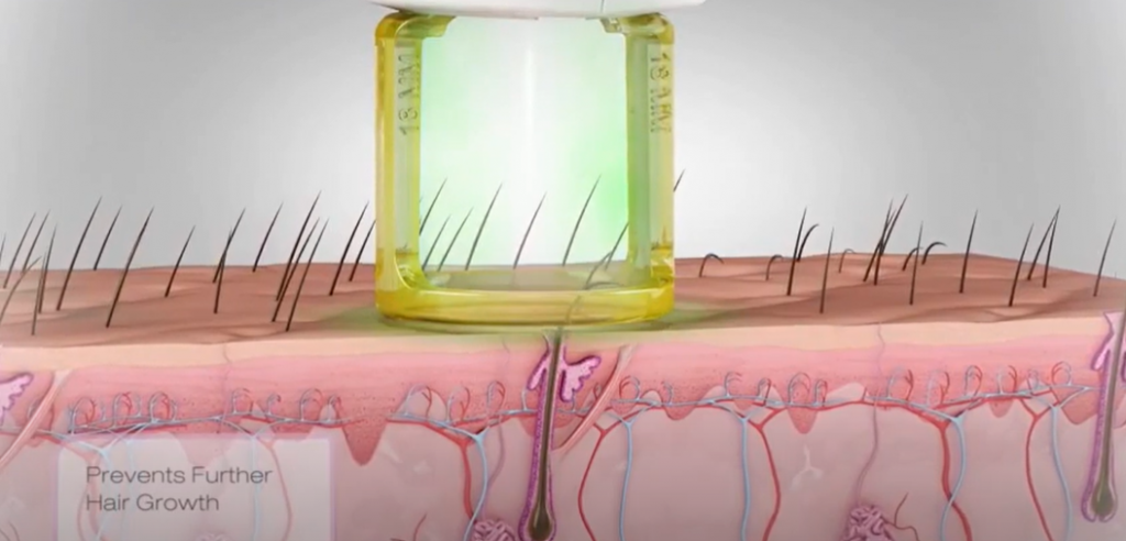 Технология апарат GentleLase