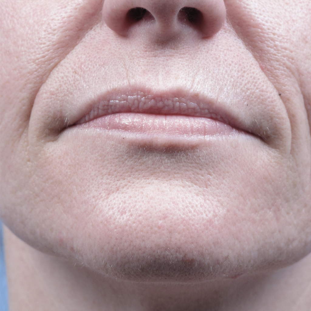 Преди процедура с Forma