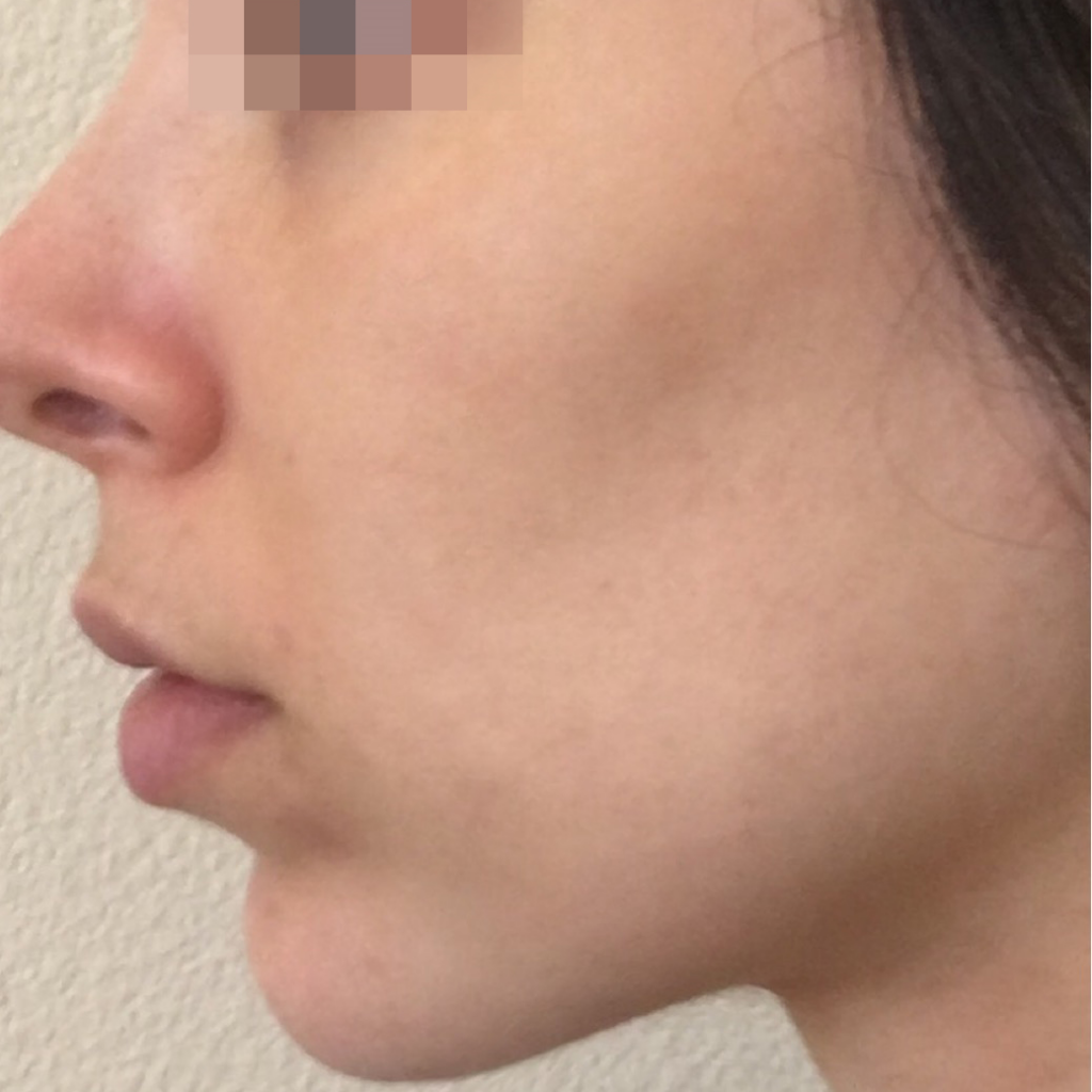 След процедура с Lumecca