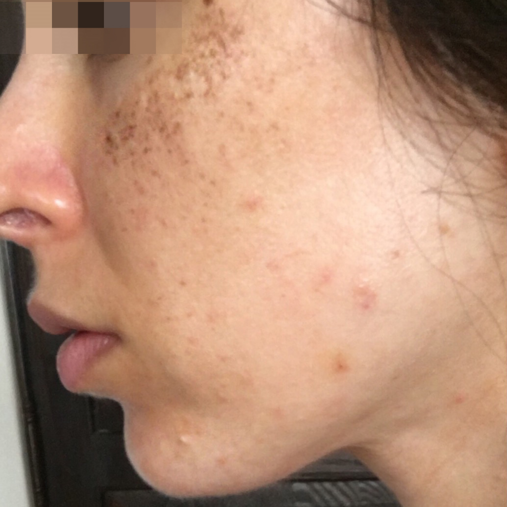 Преди процедура с Lumecca