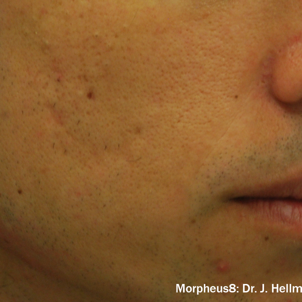 След процедура с Morpheus8