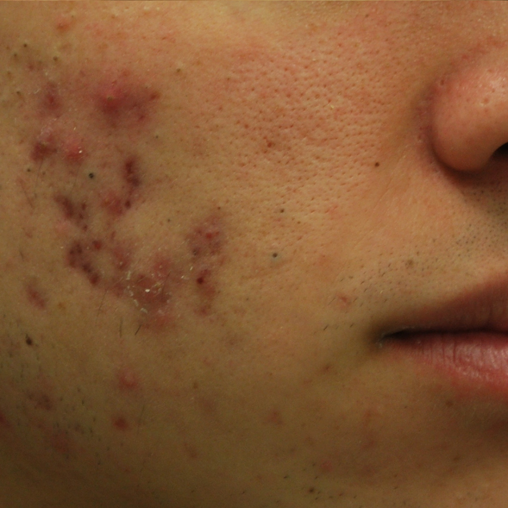 Преди процедура с Morpheus8