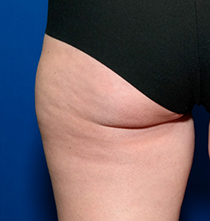 След процедура с NuEra Tight