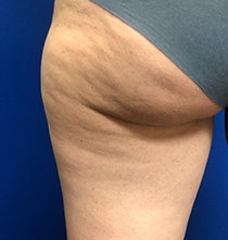 Преди процедура с NuEra Tight