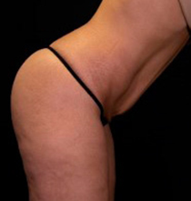 След процедура с NuEra Tight