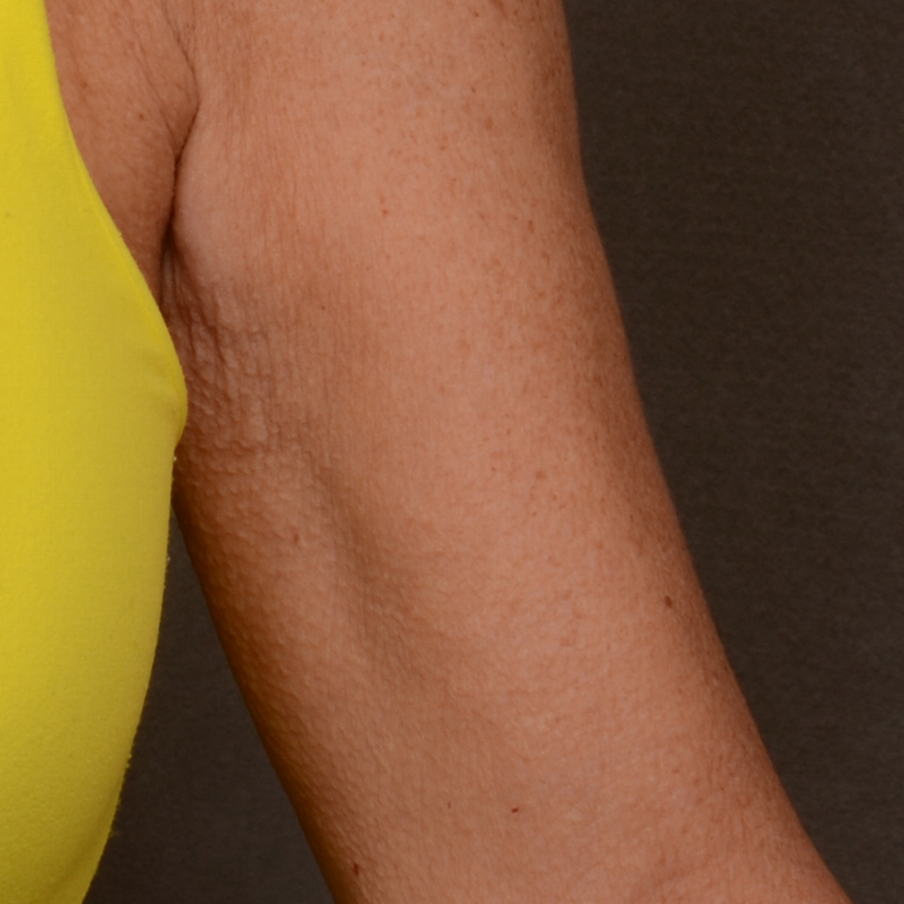 След процедура с апарата Optimas