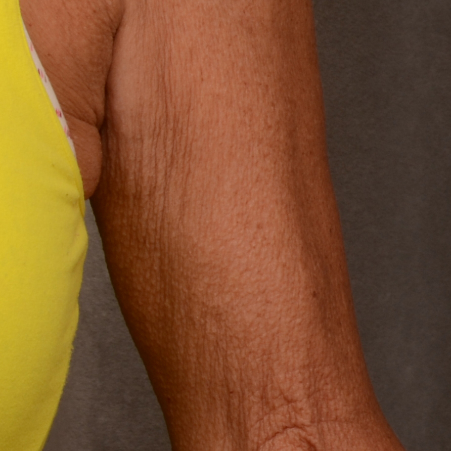 Преди процедура с апарата Optimas