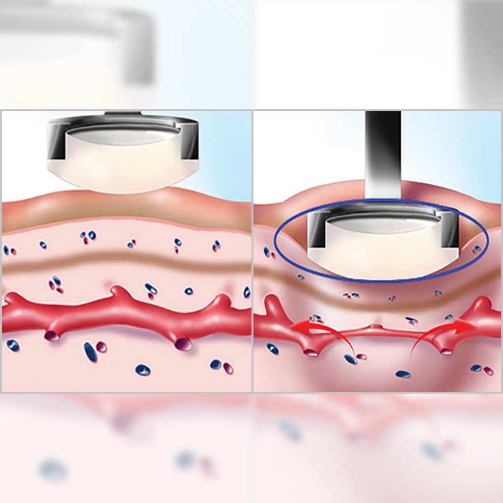 НАКРАЙНИК – 595 nm