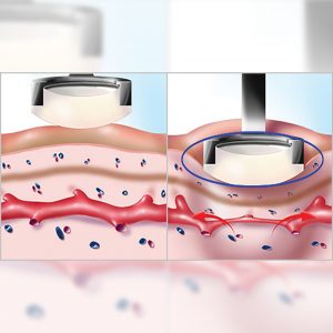 НАКРАЙНИК – 595 nm