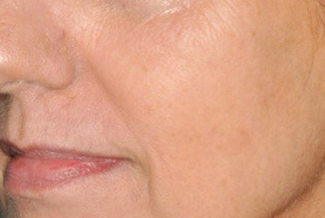 След процедура с FraxPro