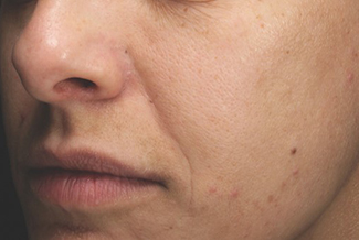 Преди процедура с FraxPro