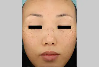 Преди процедура с Picoway