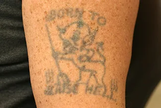 Преди процедура с Picoway