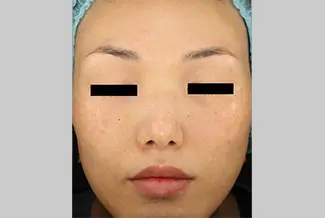 След процедура с Picoway