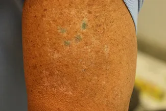 След процедура с Picoway