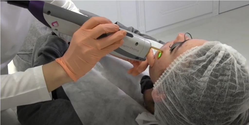 Vbeam Perfecta процедура