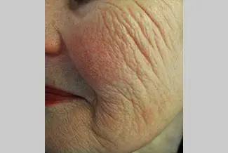 Преди процедура с Profound