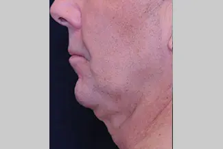 Преди процедура с Profound