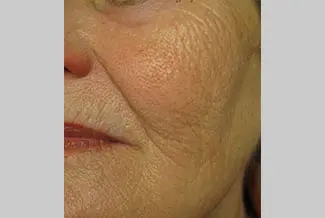 След процедура с Profound