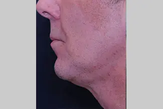 След процедура с Profound