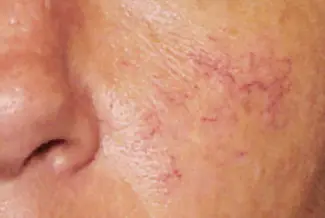 Преди процедура с Vbeam