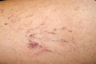 Преди процедура с Vbeam