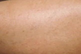 След процедура с Vbeam