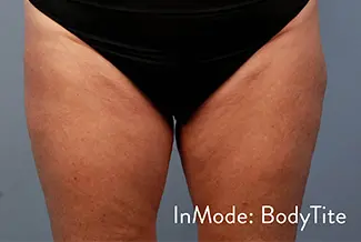 След процедура с BodyTite