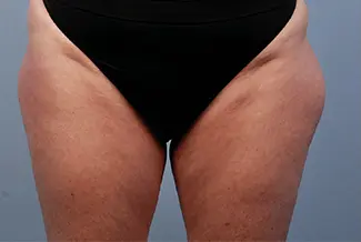 Преди процедура с BodyTite