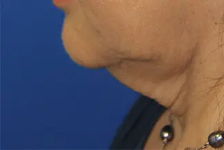 Преди процедура с BodyTite