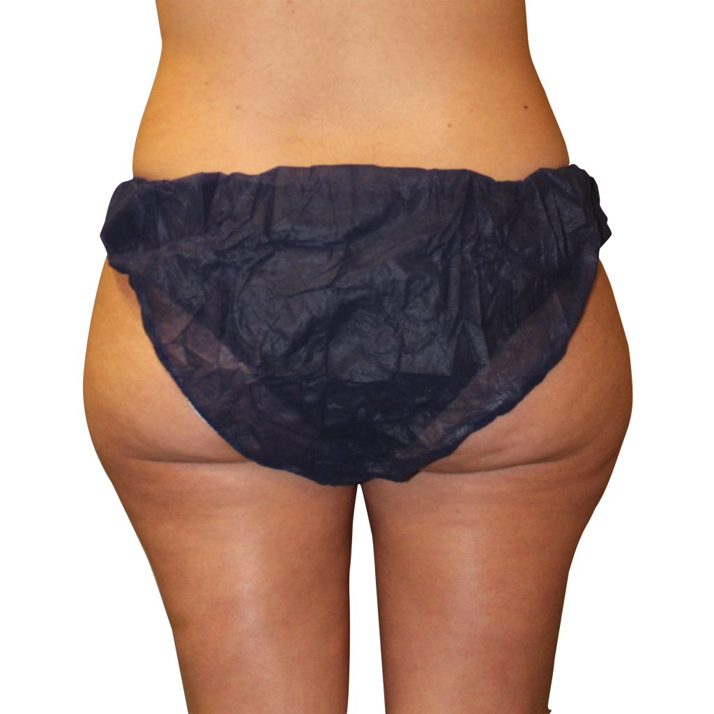 След процедура с Cooltech Define