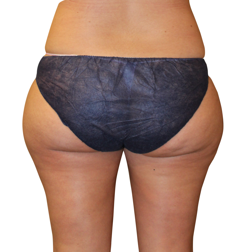 Преди процедура с Cooltech Define