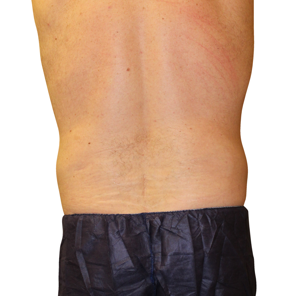 След процедура с Cooltech Define