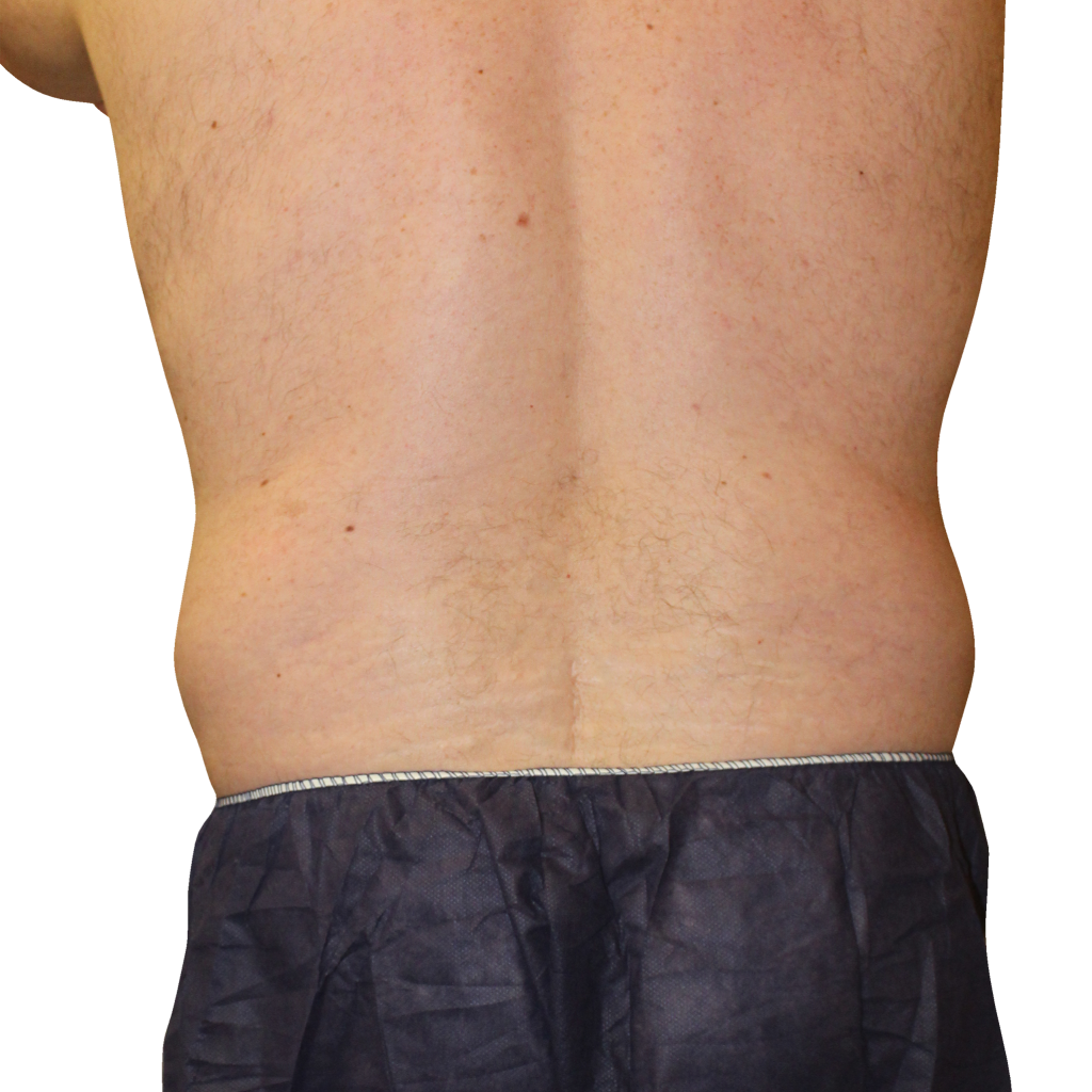 Преди процедура с Cooltech Define