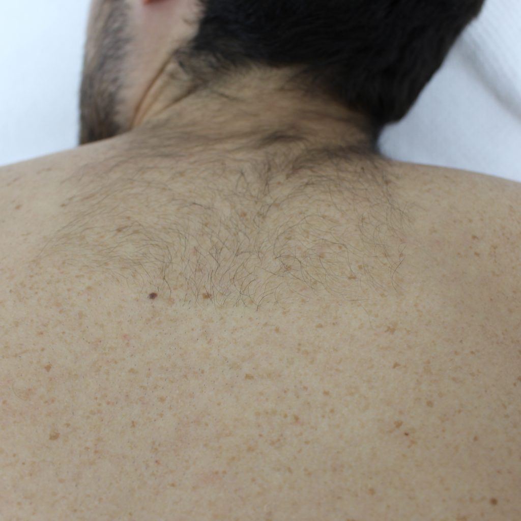 PrimeLase преди процедура