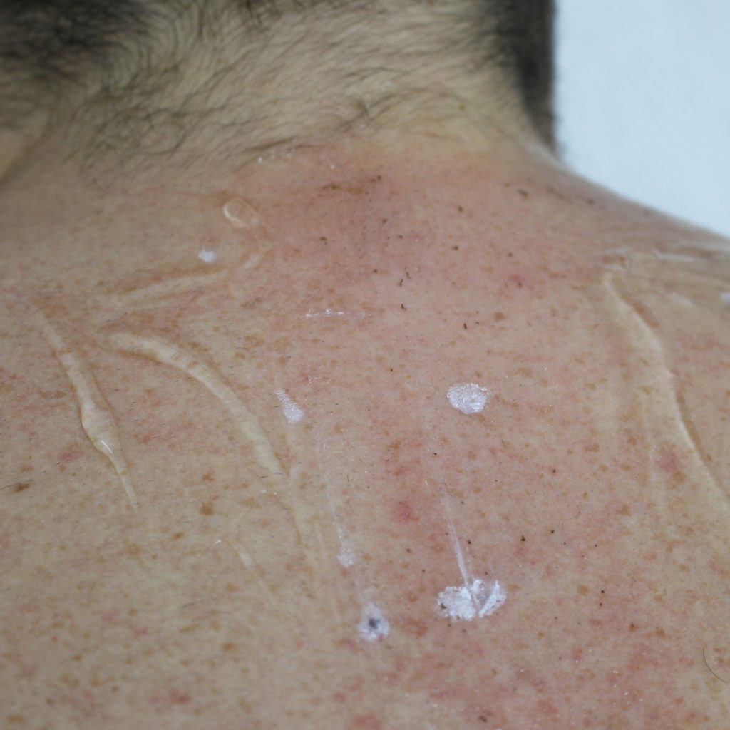 PrimeLase след процедура