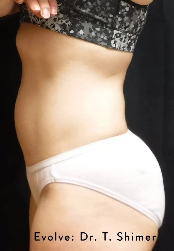 След процедура с апарата Evolve