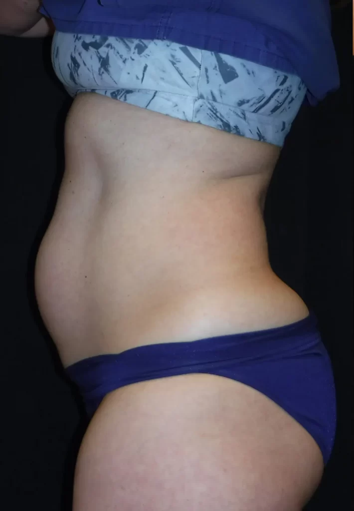 Преди процедура с апарата Evolve